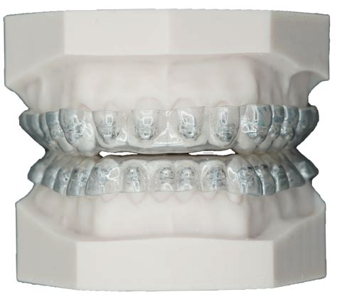 smartsmile orthodontics 00 NC: $2,175