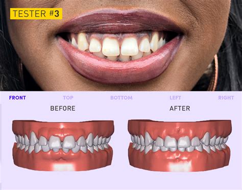 smile direct worst teeth  Its aligners have been successful for the majority of