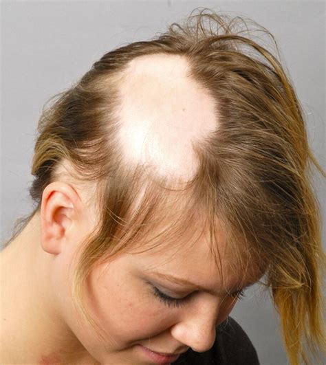 sonhar com alopecia , F