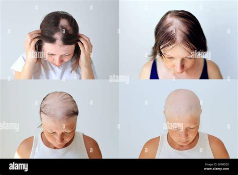 sonhar com alopecia  3