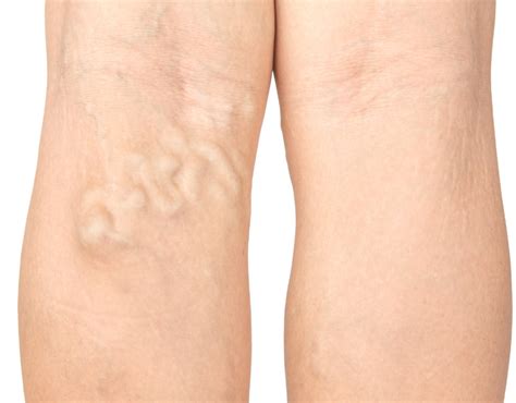 spider veins hunt valley  Call Us 410-666-3960If you're struggling with the appearance of spider or varicose veins, vein therapy may be the solution you've been looking for