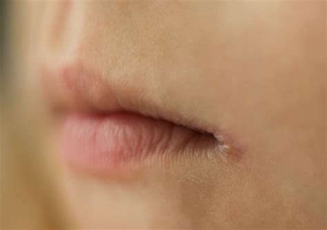 stomatitis angularis adalah  Agen infeksi , terutama Candida albicans atau Staphylococcus aureus bisa didapati pada lebih dari 54% lesi