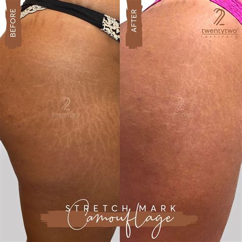 stretch mark camouflage las vegas  This is just 1 of 16 PMU techniques