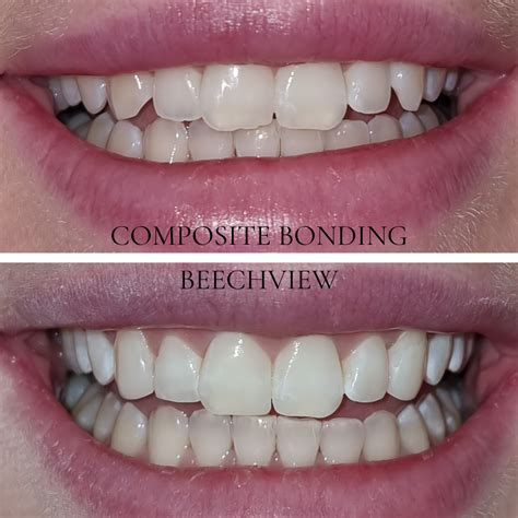 teeth bonding valley village  To learn more or to find out if this procedure is right for you, call our Spokane dental office at 509-319-2152