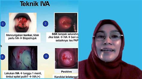 tes iva adalah  (IVA) adalah pemeriksaan leher rahim secara visual menggunakan asam cuka dengan mata telanjang untuk mendeteksi abnormalitas setelah pengolesan asam cuka 3-5%