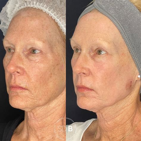 thermirf dallas  Also known as "Symphony RF," this wrinkle reduction and skin tightening treatment can target the subdermal