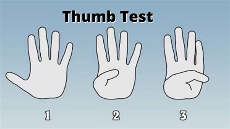 thumb test aortic aneurysm  Wrist or thumb sign — 1