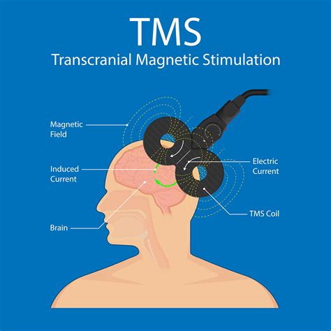 tms for depression in everett Transcranial magnetic stimulation (TMS), a research tool with various effects on brain cells, can depolarize cerebral neurons noninvasively