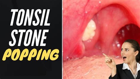 tonsisolitos A tonsillectomy is usually recommended for kids who have: recurrent tonsillitis or strep infections