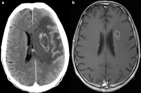 toxoplasmosis ct scan  Please refer on congenital toxoplasmosis to a broad discussion on epidemiology and pathology