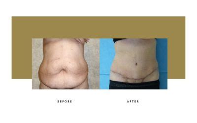 tummy tuck okanagan  This process helps create an abdominal profile that is smoother and firmer