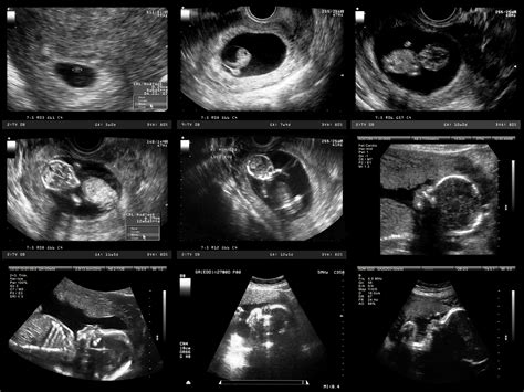 ultrasound baby scan  The physical principles of acoustic waves