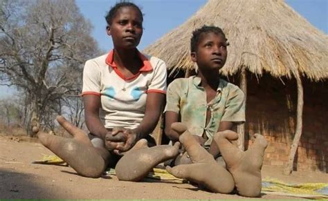 vadoma people  Living in the districts of Urungwe, Sipolilo and the Zambezi River Valley, its members are known for having the inherited condition of ectrodactyly, caused by a mutation of the 7th chromosome