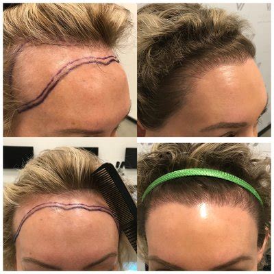 varona hair restoration reviews Jun 19, 2019 - Dr