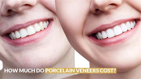 veneers cost el paso  Both dental bonding and veneers enhance the look of your smile and blend right in with your natural teeth