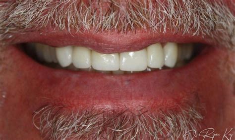 veneers in encinitas , Encinitas, CA 92024