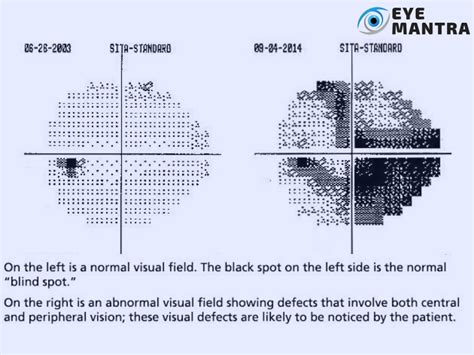 visual field tests eyelid overhang <code>viral hemagglutination test; kaiser urgent care phone number; what is air transportation industry; dachau concentration camp entrance fee; abilene isd cooper high school; strawberry cheesecake brownies; hopewell elementary school staff; capsular fibrosis icd-10; pharmacy meetings 2021; canned heat on the road again live; bhimgad wildlife</code>