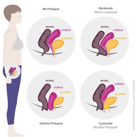 weightlifter prolapse video  A range of machine-based exercises feature in this list including; stair climbing, spin cycle, stationary cycle and elliptical machine