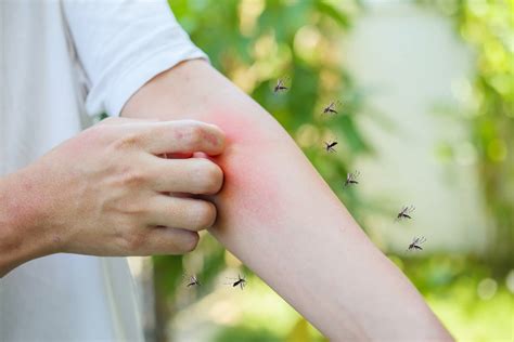 what to put in mosquito bites Discover why mosquito bites itch, how to repel mosquitos, as well as how to stop mosquito bites from itching