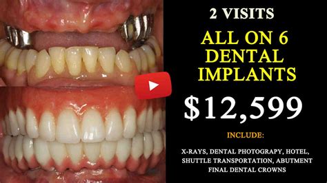 yuba city dental implants cost  Very professional and a Great staff! Kathy M