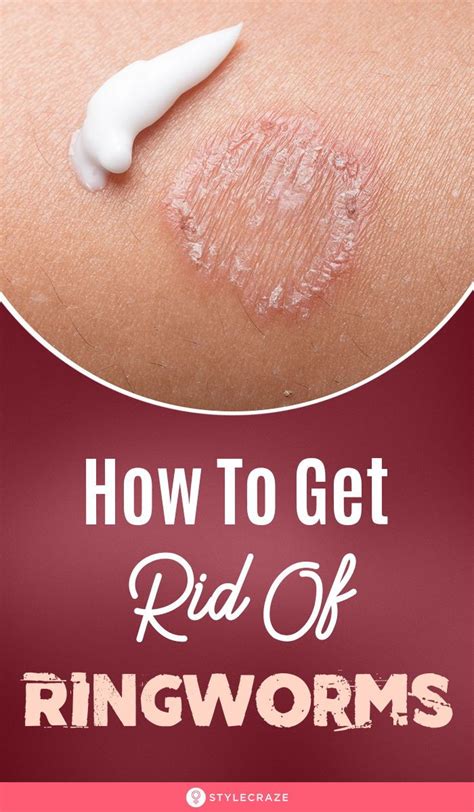 21 Home Remedies for Ringworm