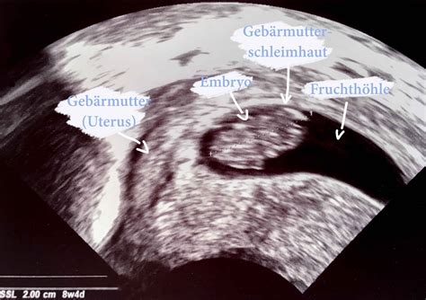 25 ssw stechen in der scheide
