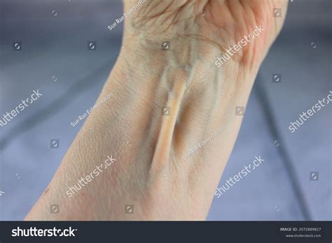 276 Palmaris longus Images, Stock Photos & Vectors - Shutterstock