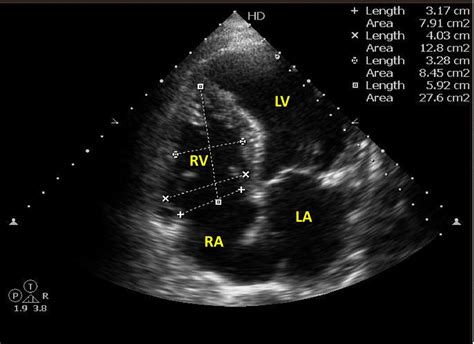 2d Echo Normal Report