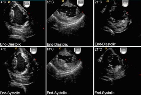 2d Echo Test Normal Report