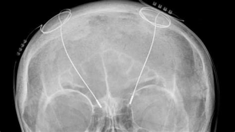 3 D Computer Model May Help Refine Target for Deep Brain Stimulation Therapy for Dystonia
