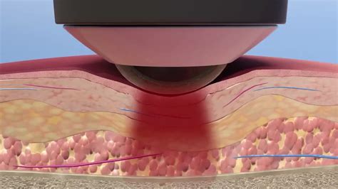 3 Laser-Tissue Interactions Explained - LightForce Therapy Lasers