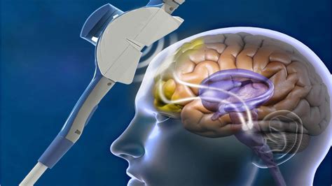 3 The procedure Repetitive transcranial magnetic stimulation ... - NICE