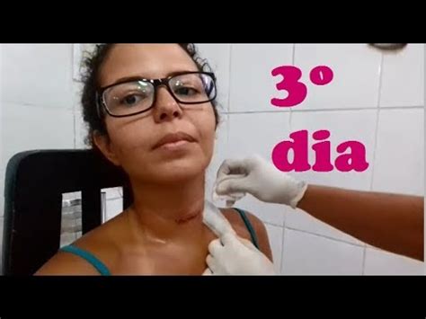 3 dias apos Tireoidectomia Trocando curativo em casa