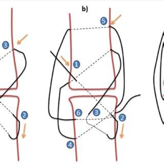 3 Loop Pulley Suture
