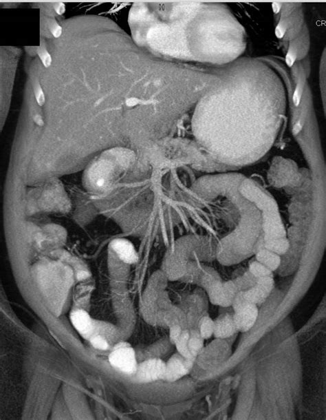 31 Radiation Injuries to the Small and Large Intestines