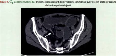 354 : Syndrome occlusif de l