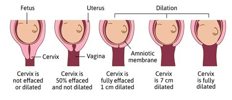 Cervical Dilation in the First Stage of Labor. Early phase: The cervix will dilate from 1 cm to 3 cm with mild contractions. Active phase: The cervix expands from 4 cm to 7 cm and contractions become more intense and regular. Transition phase: The cervix dilates to 10 cm. Transition ends when the cervix has reached 10 cm and is fully dilated.. 