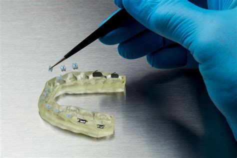 3D Printing Indirect Bonding Trays Formlabs Dental