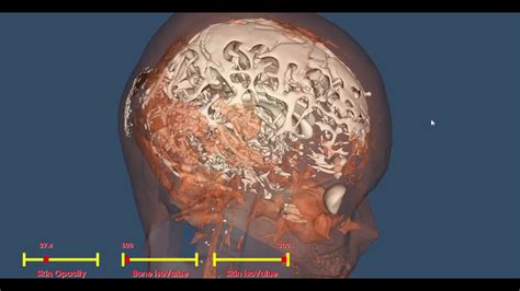 3D Reconstruction of Human Head CT Images Based on VTK