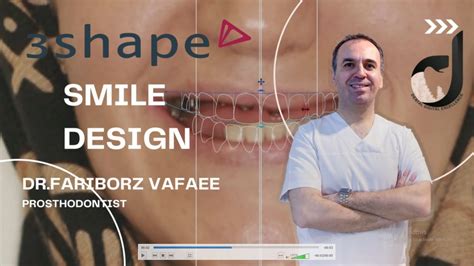 3Shape Smile Design - YouTube