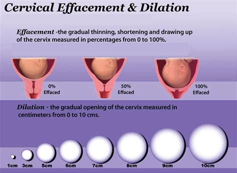 3cm dilated 75 effaced. Doctors track cervical effacement through percentages: A cervix that is 100% effaced has gone from the shape of a thick-walled cone to that of a flat, thin cup beneath the baby's head. 