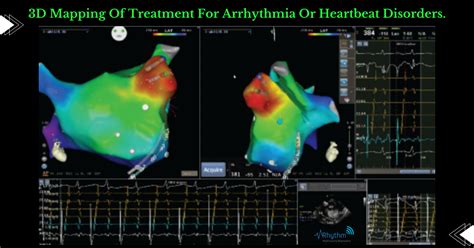 3d Mapping Of The Heart