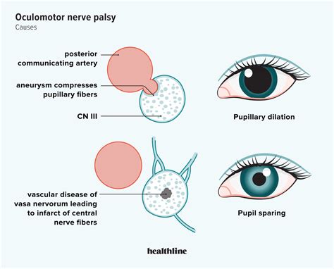 3rd Nerve Palsy