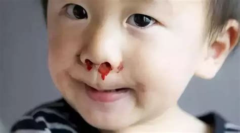 3岁宝宝流鼻血怎么止血