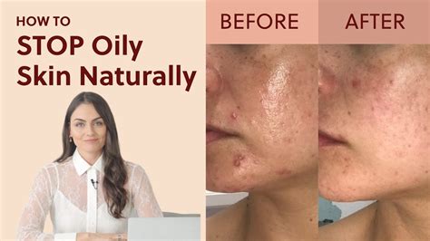 4 Vitamins for Oily Skin To Stop Oily Skin Naturally