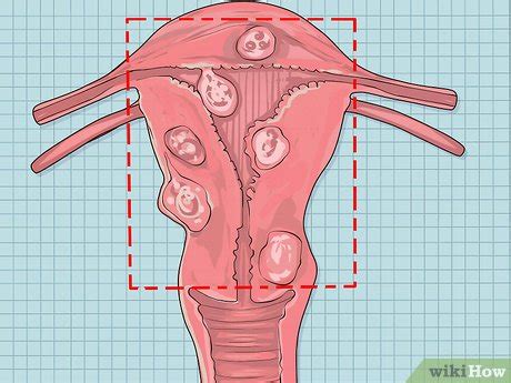 4 Ways to Decide if You Need a Hysterectomy - wikiHow