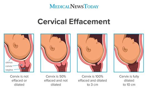 A) The cervix is 4 cm dilated, it is effaced 80%, and the presenting part is 2 cm above the ischial spines When assessing the fetus using Leopold maneuvers, the nurse feels a round, firm, movable fetal part in the fundal portion of the uterus and a long, smooth surface in the mother’s right side close to midline.. 