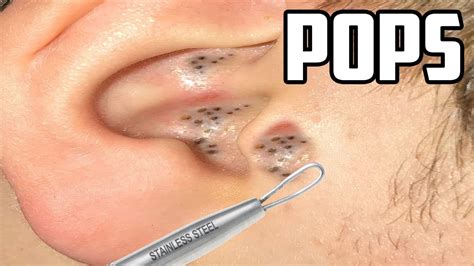 Nov 14, 2021 · Crazy Deep Ingrown Hairs Removed. Pulling blackheads from ears, painful blackhead in ear canal, how to remove deep blackheads in ear, popping blackheads in ears, nasty ear blackheads, 4 year old with blackheads in ear, child ear blackheads.. 