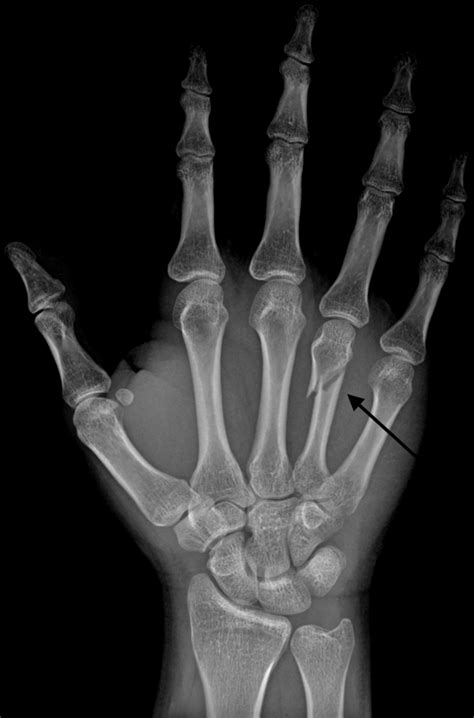 4th metacarpal fracture