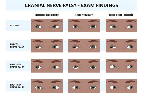 4th Nerve Palsy